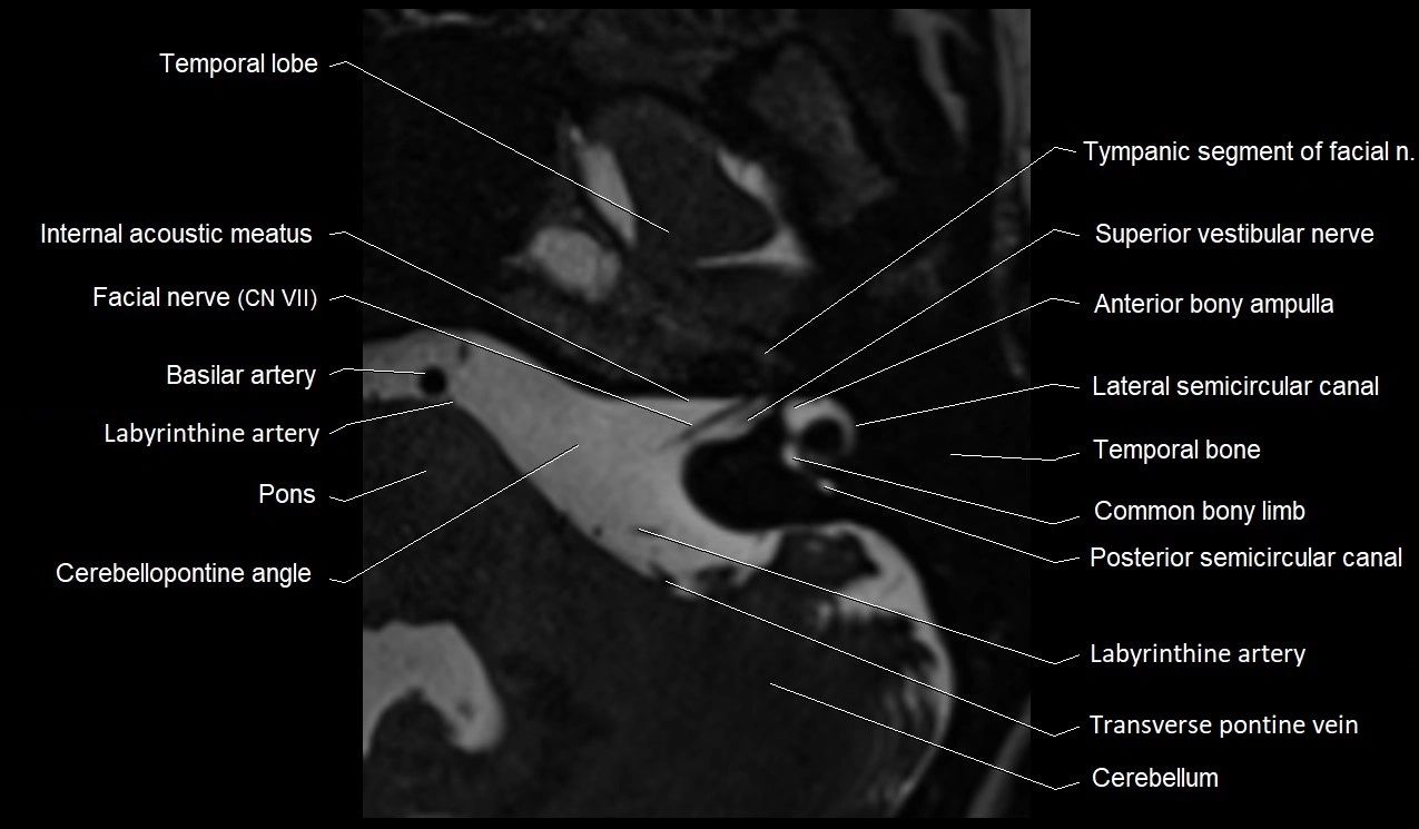 Internal auditory canal (IAC) axial cross sectional anatomy image 16.webp